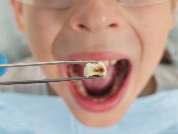 Best Emergency Tooth Extraction in Norris City, IL